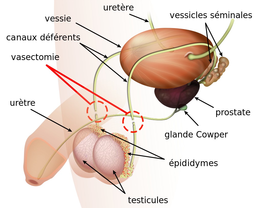 Schéma vasectomie